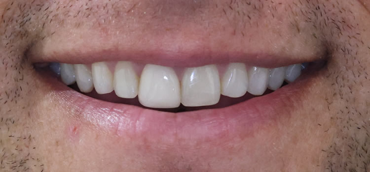 Veneers dentist Newport Beach