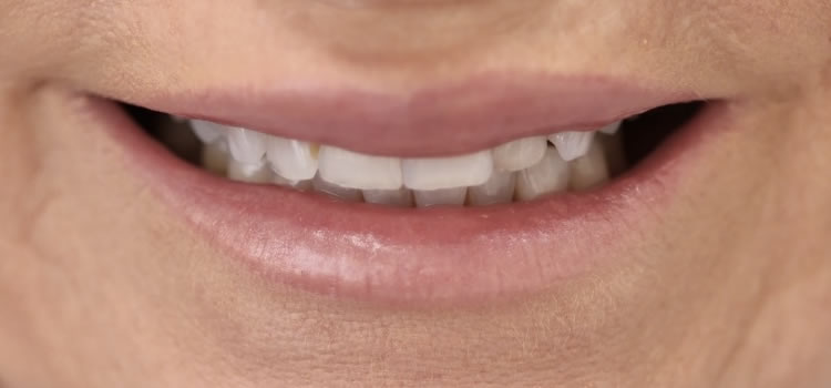 Best Veneer Dentist Newport Beach