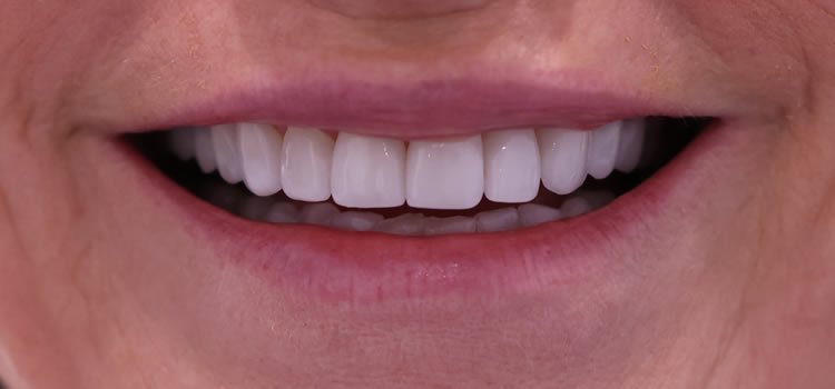 Best Veneer Dentist Newport Beach Ca