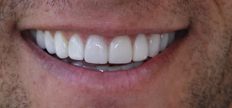 Veneers dentist Newport Beach Ca