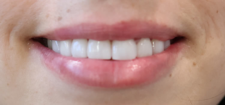 Veneers dentist Newport Beach Ca Newport Smile Studio The Gentle Dentist