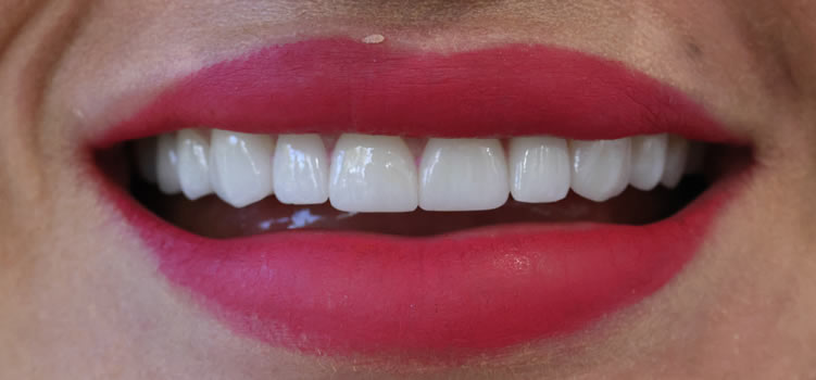 Veneers Dentistry Newport Beach Ca