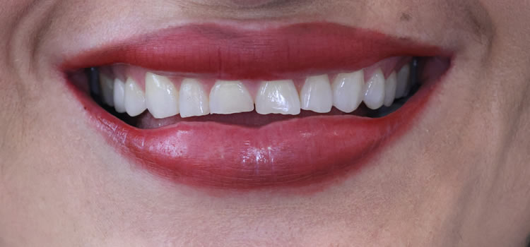 Veneers Dentistry Newport Beach