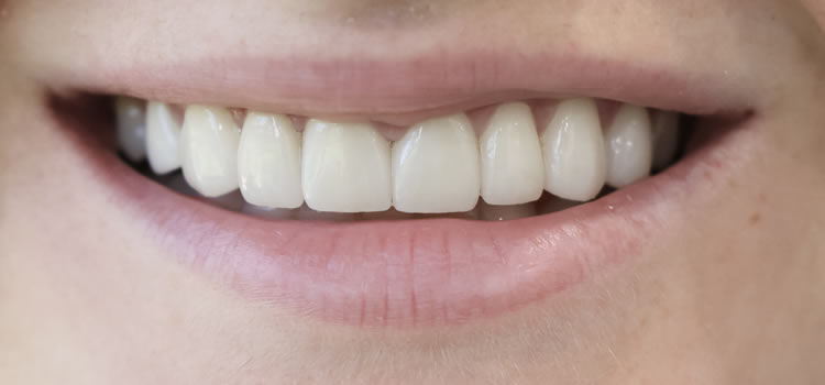 Veneers After Newport Beach Newport Smile Studio