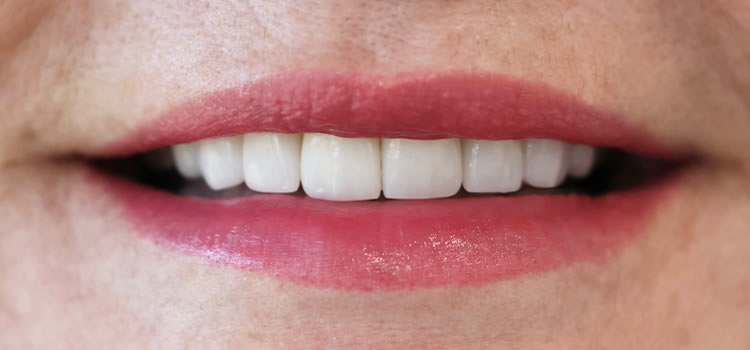 Veneers After Newport Beach