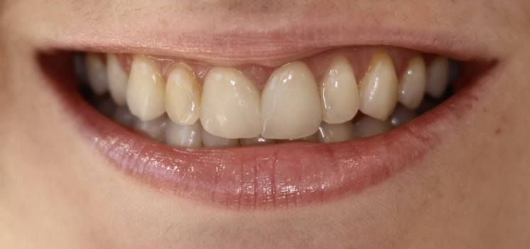 Veneers Before Newport Beach Newport Smile Studio