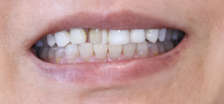 Veneers in Newport Beach Ca Newport Smile Studio