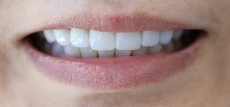 Veneers in Newport Beach Ca